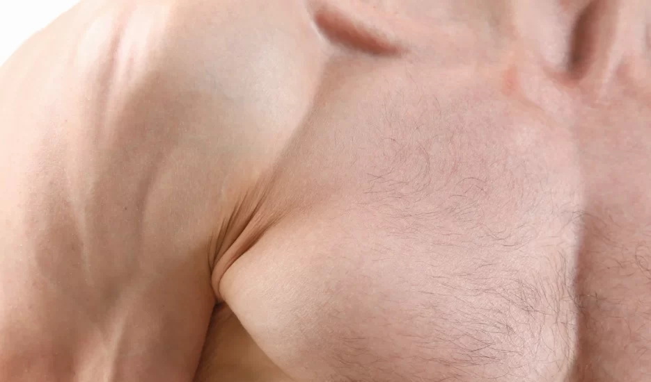 La Ginecomastia