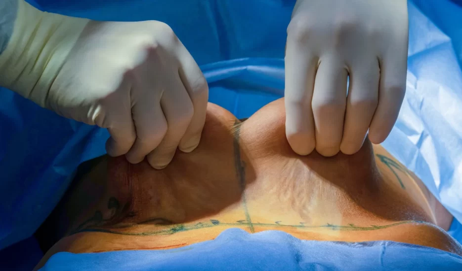 La Abdominoplastia