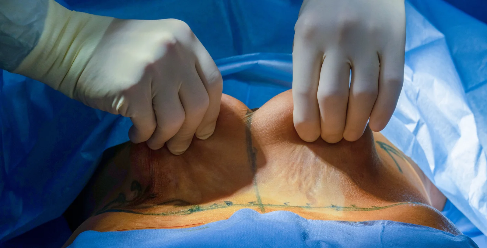 La Abdominoplastia