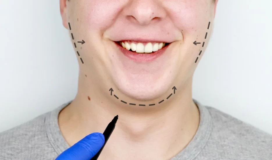 Mentoplastia