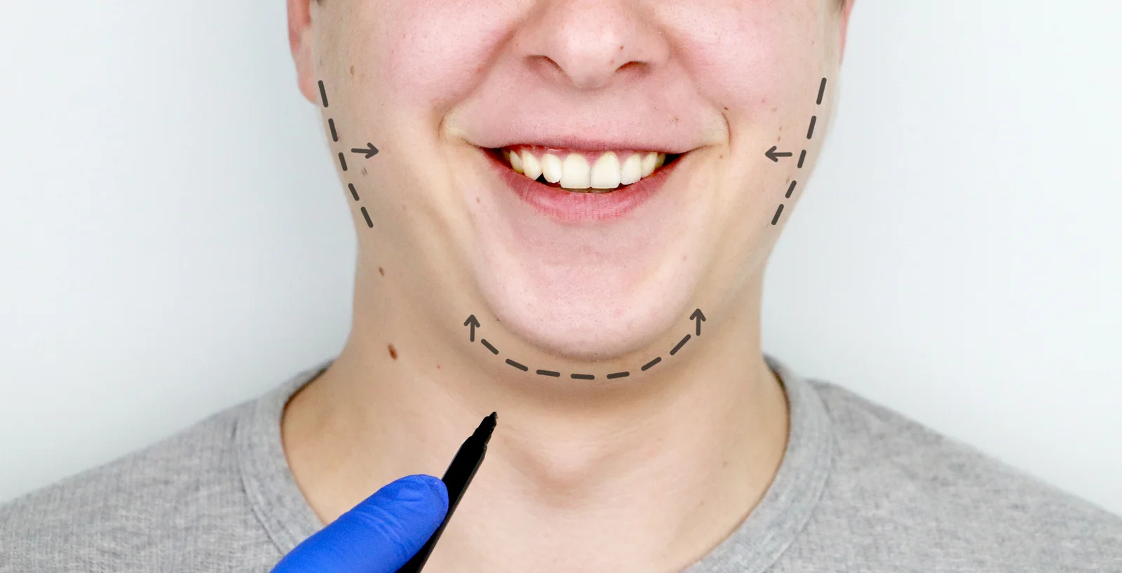 Mentoplastia