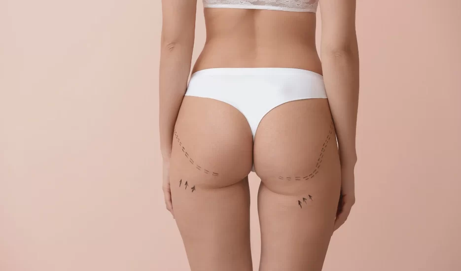 La Gluteoplastia