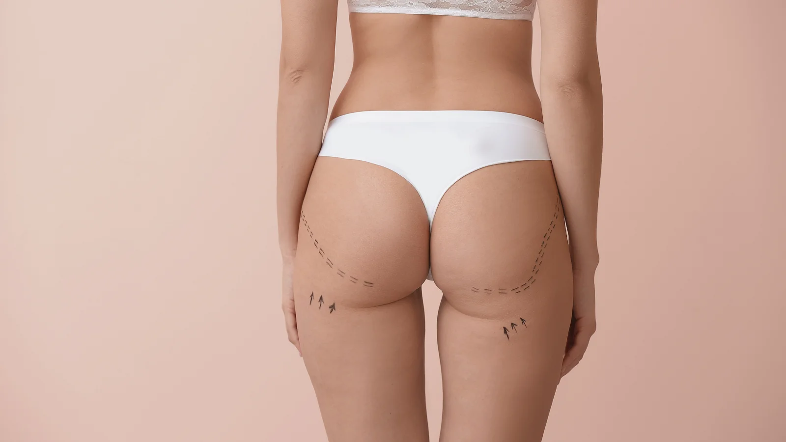 La Gluteoplastia